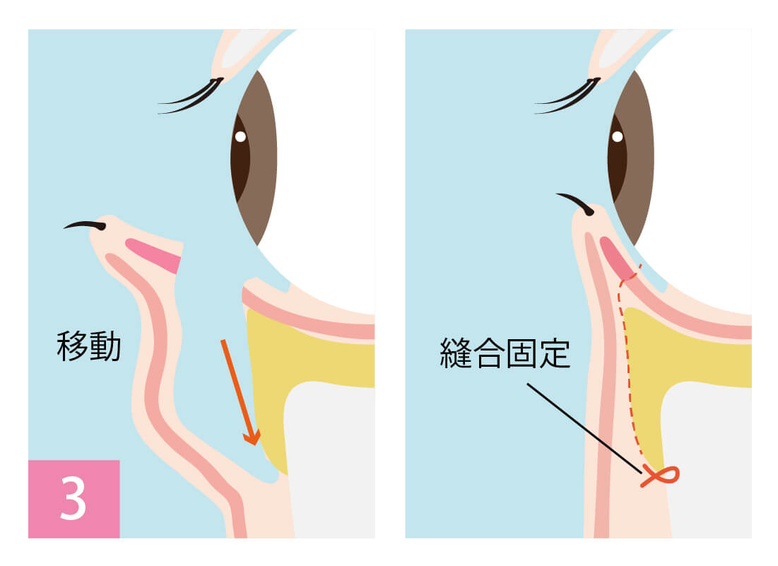 手術内容 イメージ③