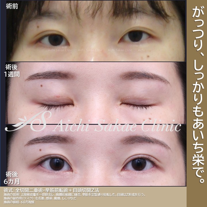たるみ 0000A-E9110-141_A_L_grande.jpg